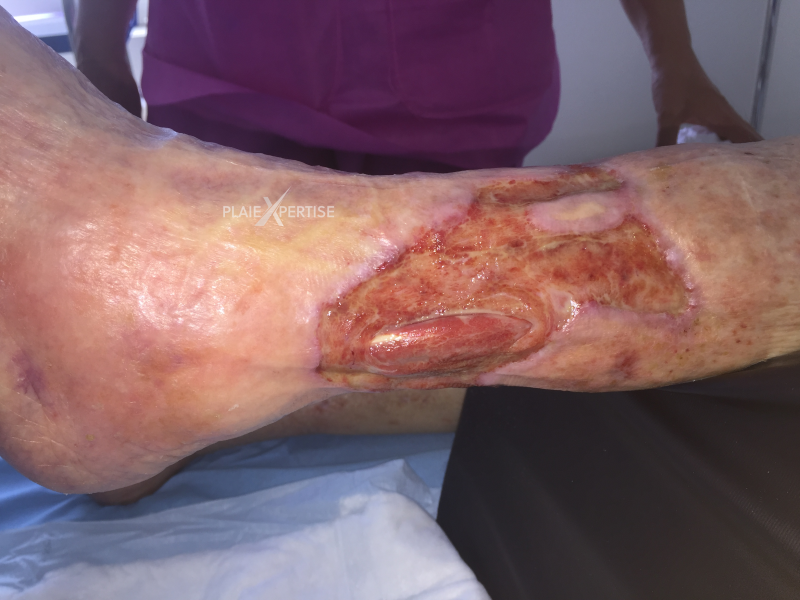 Fichier:Tendon-Voussure16.png