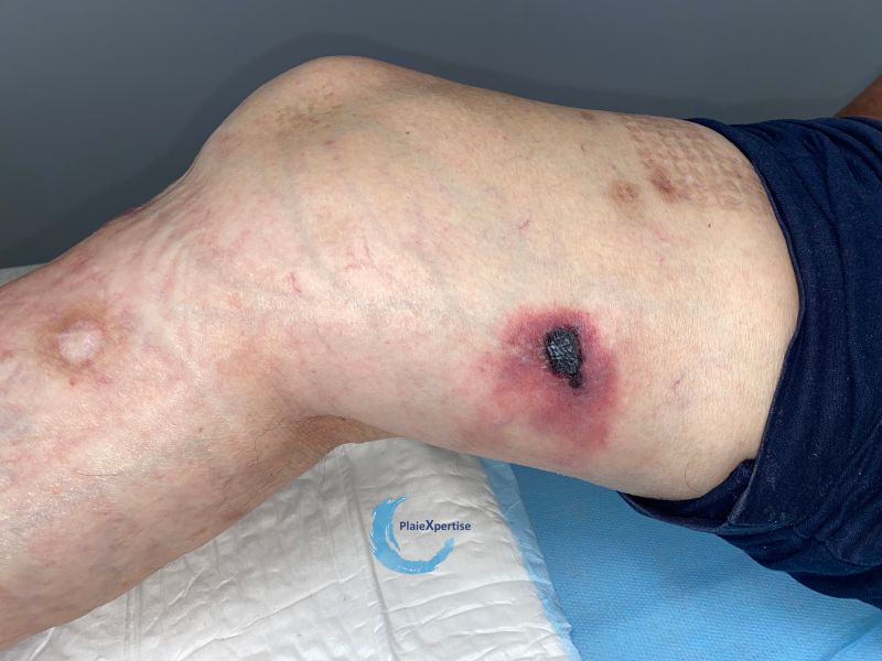 Fichier:Calciphylaxie17.jpg