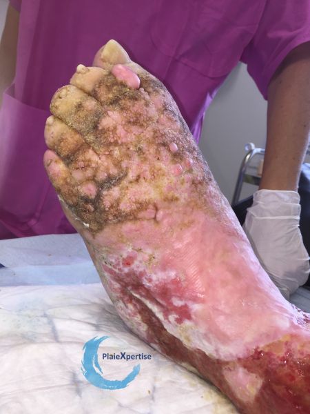 Fichier:Lymphoedème44.jpg