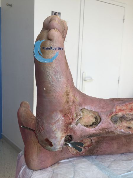 Fichier:Plaies transfixiantes9.jpg