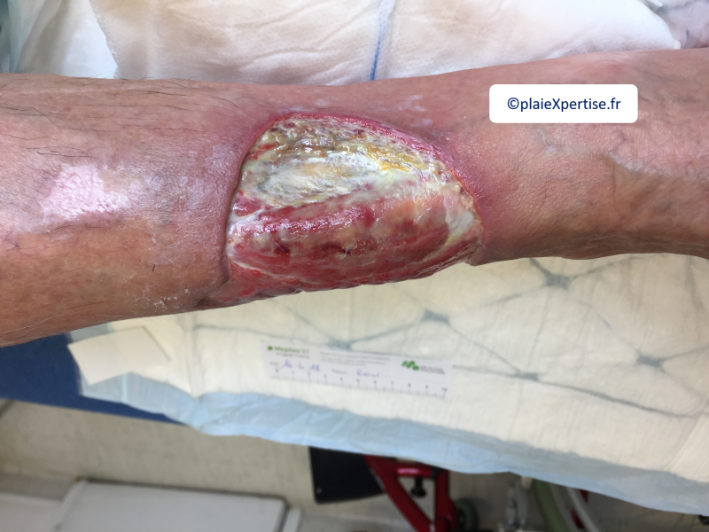 Fichier:Tendon-Voussure4.png