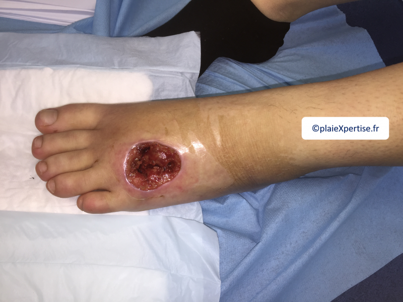 Fichier:Cou de pied19.png