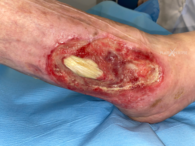 Fichier:Tendon normal24.png