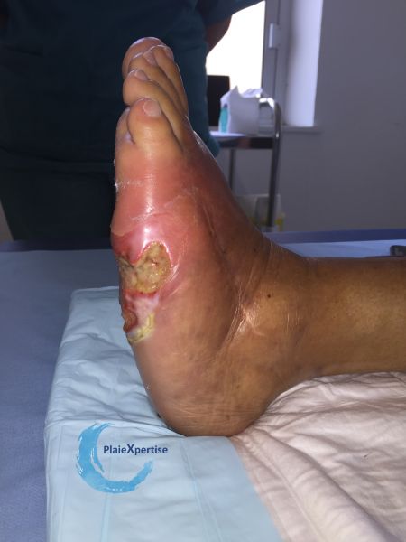 Fichier:Pied de Charcot30.jpg