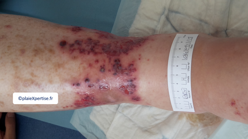Fichier:Purpura pustuleux1.png