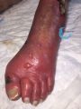 Erythrocyanose7.jpg