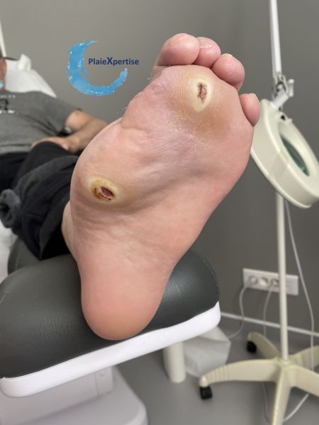 Fichier:Pied de Charcot23.jpg