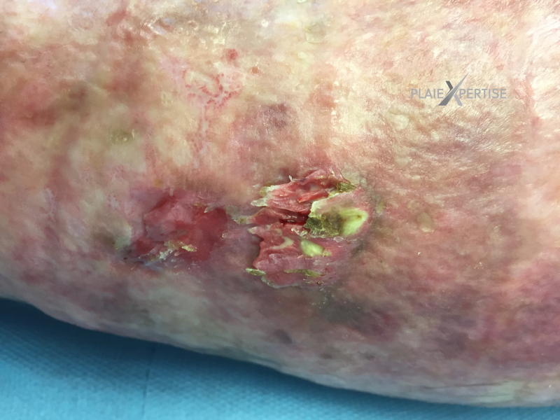 Fichier:Epidermolyse bulleuse acquise4.png