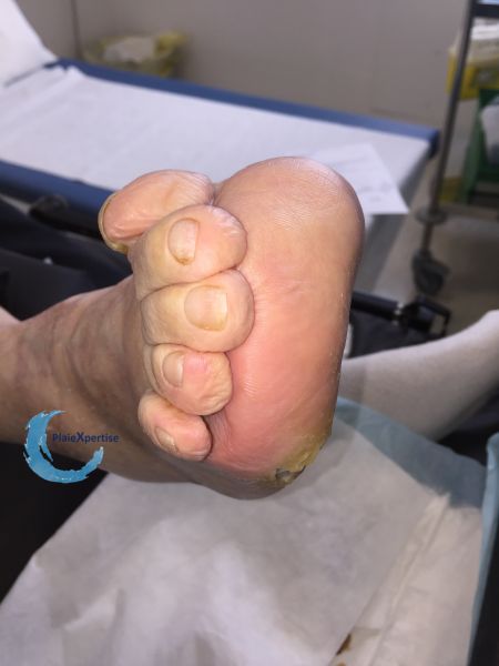 Fichier:Pied déformé6.jpg