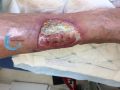 Tendon-Voussure20.jpg