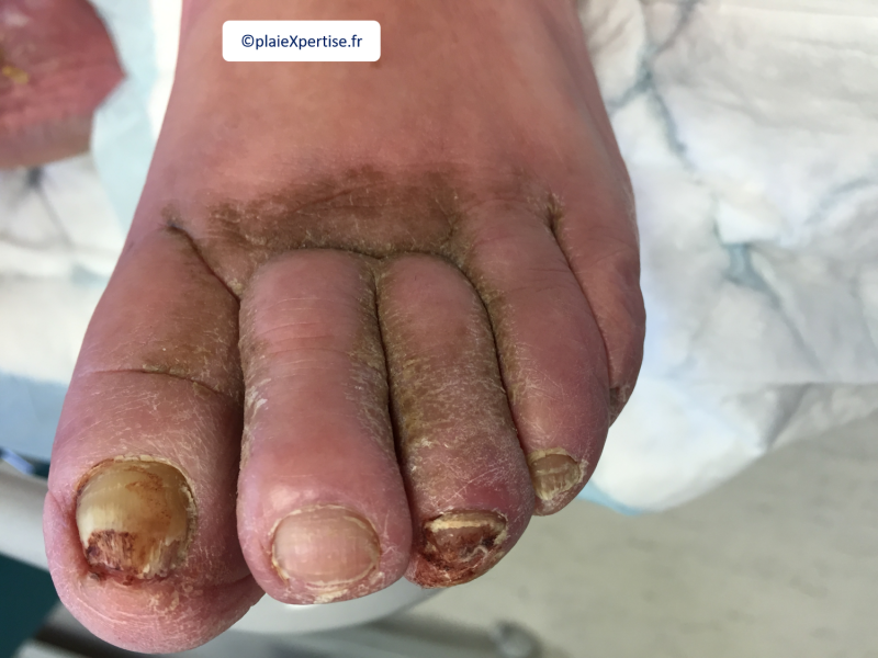 Fichier:Lymphoedème pied3.png
