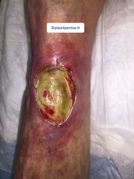 Fichier:Tendon-Voussure3.png
