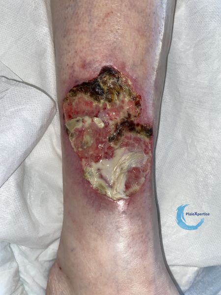 Fichier:Angiodermite typique106.jpg