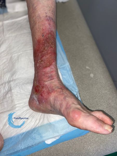 Fichier:Eczéma141.jpg