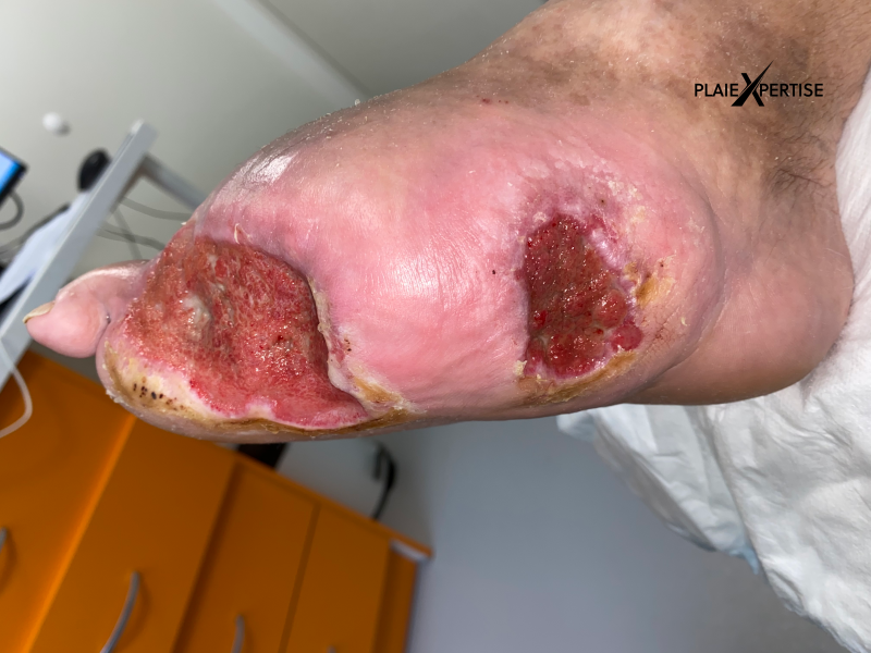 Fichier:Pied de Charcot3.png