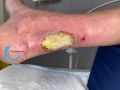 Tendon nécrotique humide68.jpg