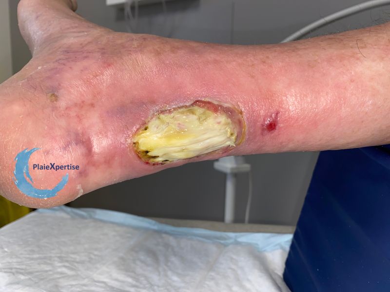 Fichier:Tendon nécrotique humide68.jpg