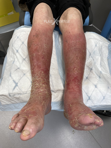 Fichier:Eczéma74.png