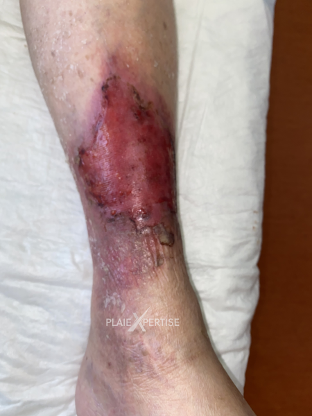 Fichier:Erosion en nappe63.png