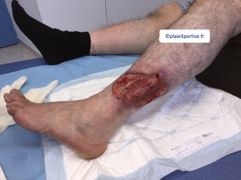 Fichier:Tendon-Voussure5.png