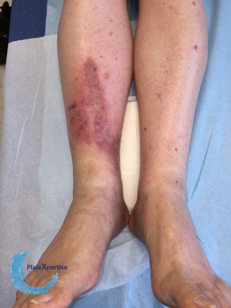 Fichier:Nécrobiose lipoïdique19.jpg