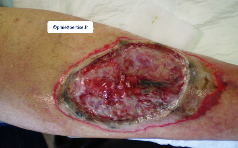 Fichier:Pyoderma gangrenosum8.png