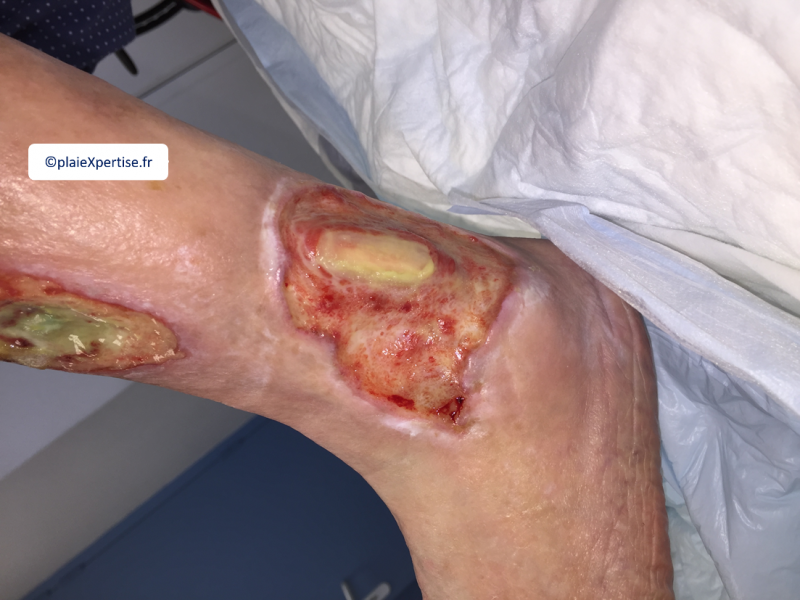Fichier:Tendon normal1.png