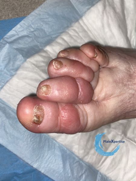 Fichier:Lymphoedème55.jpg