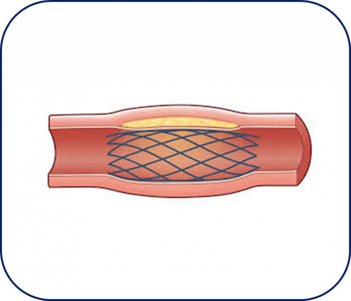 Fichier:Stent1.png
