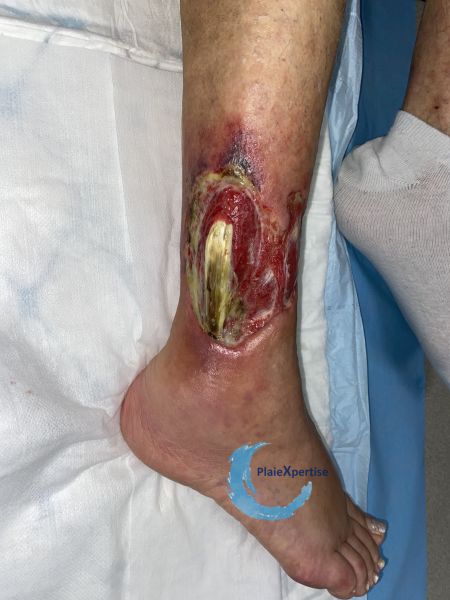 Fichier:Tendon nécrotique humide49.jpg