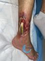 Tendon nécrotique humide49.jpg