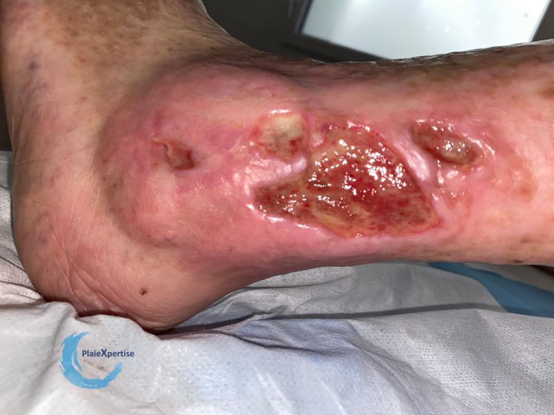 Fichier:Tissu de granulation inflammatoire47.jpg