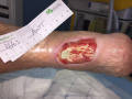 Tendon-Reliquat7.png