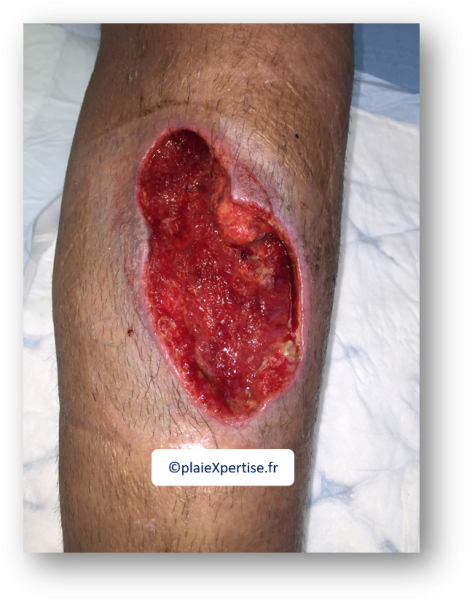 Fichier:Tissu de granulation normal6.png