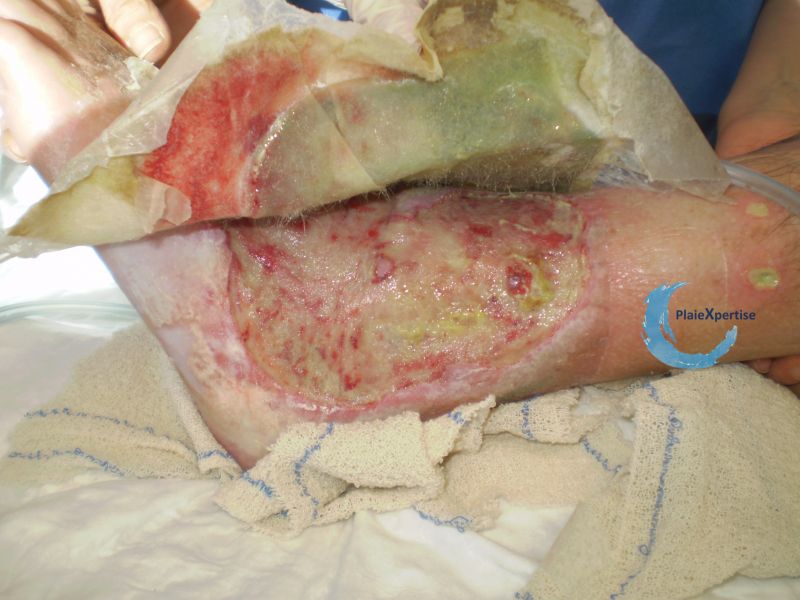Fichier:Fibrine21.jpg
