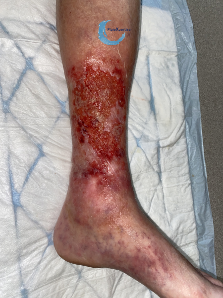 Fichier:Tissu de granulation normal33.png