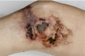 Sclerotherapy1.png