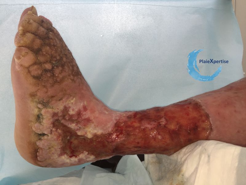 Fichier:Lymphoedème56.jpg