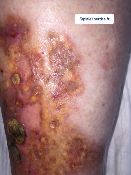 Fichier:Nécrobiose lipoïdique3.png
