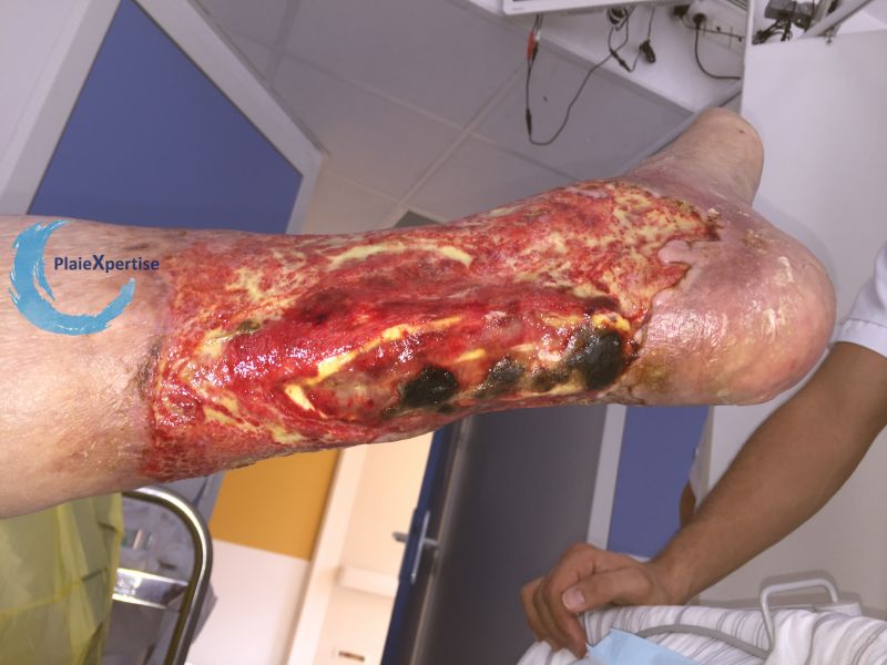 Fichier:Tendon nécrotique humide46.jpg