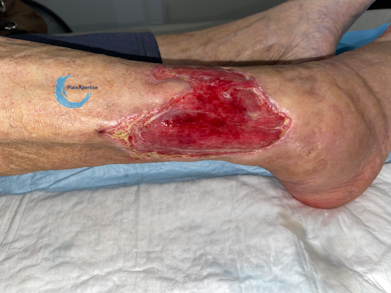 Fichier:Tissu de granulation normal38.png