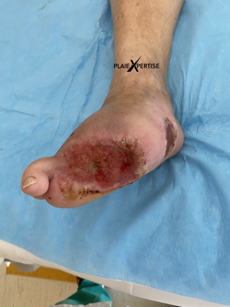 Fichier:Pied de Charcot1.png