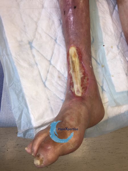 Fichier:Tendon normal30.jpg