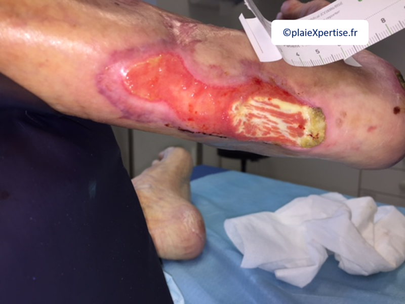 Fichier:Tendon normal6.png