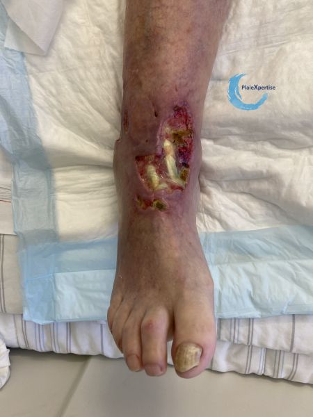 Fichier:Cou de pied93.jpg