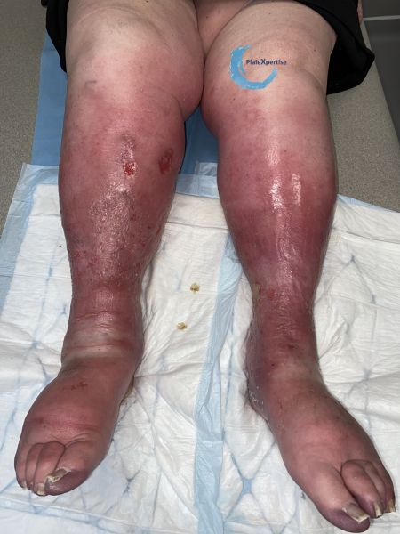 Fichier:Grosses jambes suintantes39.jpg
