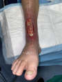 Tendon-Reliquat10.png