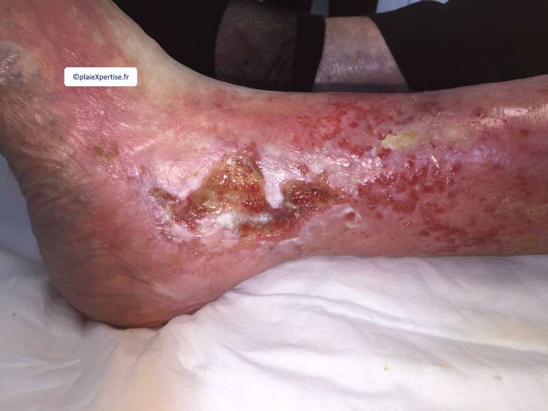 Fichier:Erosion ponctiforme moins de 5 mm4.png