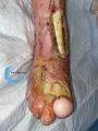 Tendon nécrotique humide60.jpg