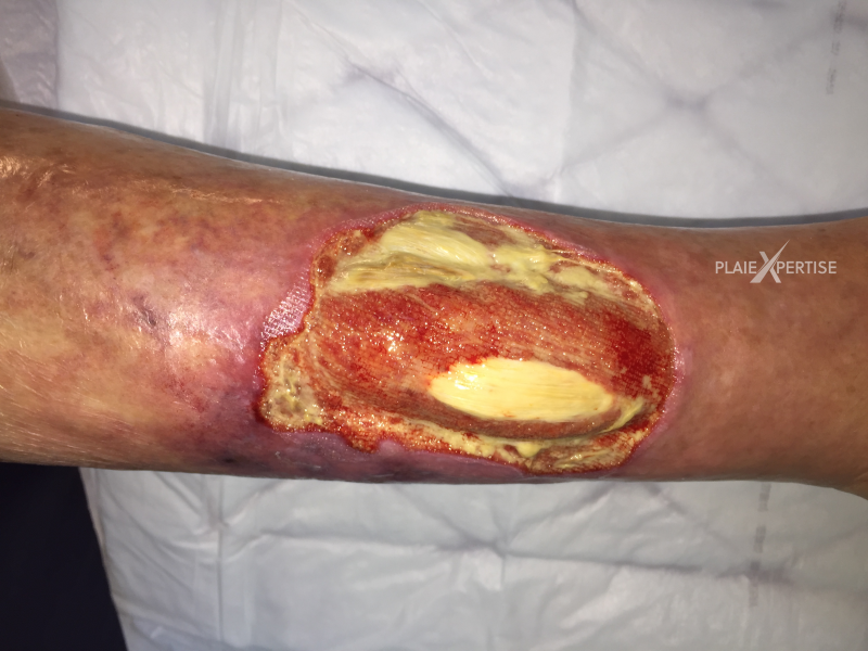 Fichier:Tendon normal28.png